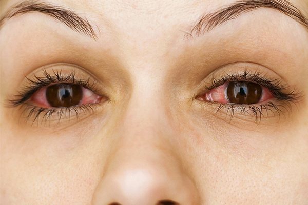 sneen valg Kan ignoreres CBD Red Eyes | Red Eyes with CBD or Eye Benefits