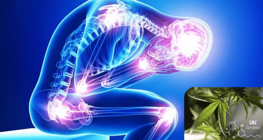 CBD et Fibromyalgie